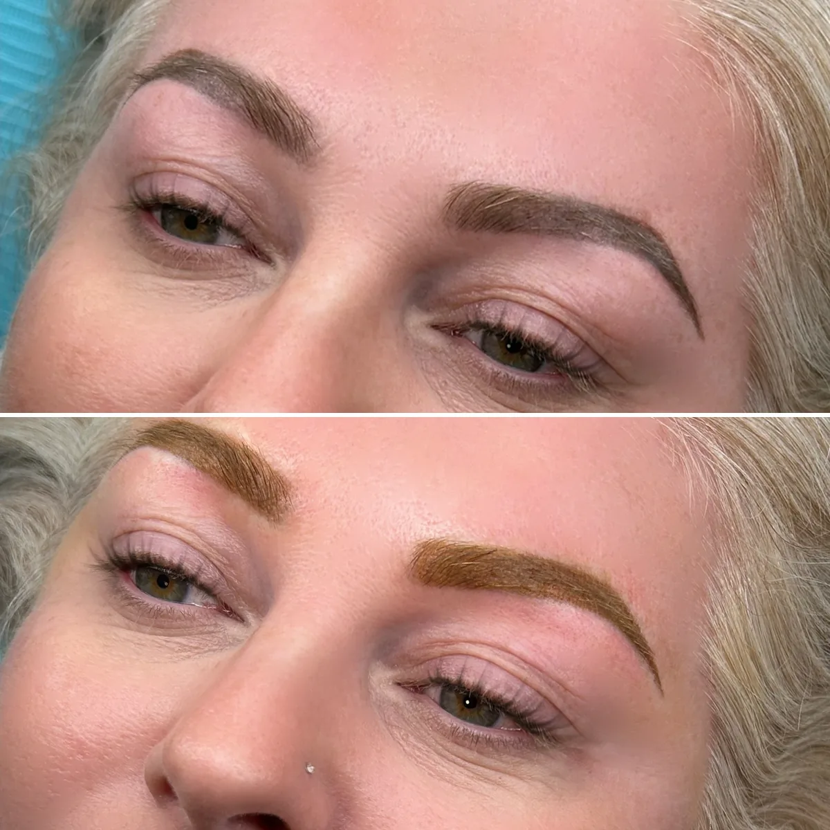 brow correction before and after